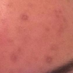 Example of acne